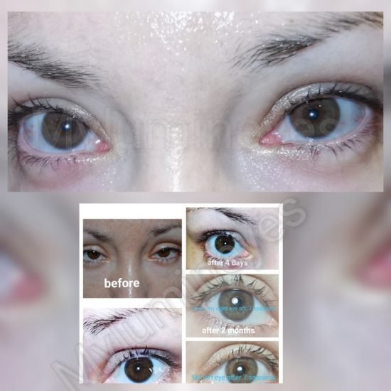 MYlumineyes Eye Center operación y cambio de color de ojos con láser