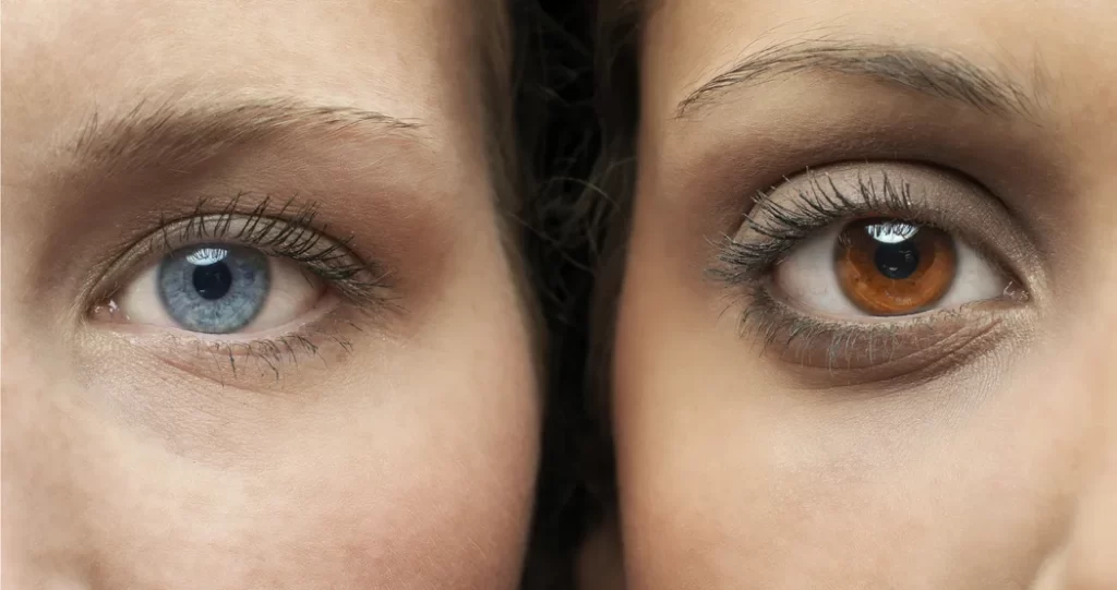 Laser-Iris-Aufhellung - Tropfen der Augenfarbe ändern