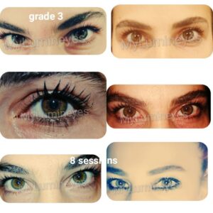 grade3 eyes brown green eye color change