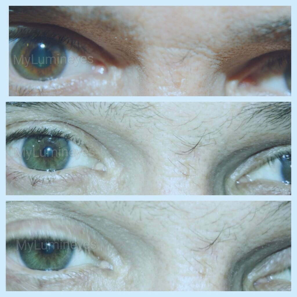 Änderungsoperation der Augenfarbe