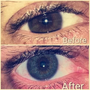 Foto der Augenfarbänderung vor und nach der Operation