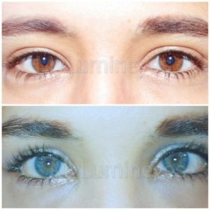 before and after photos eye color change