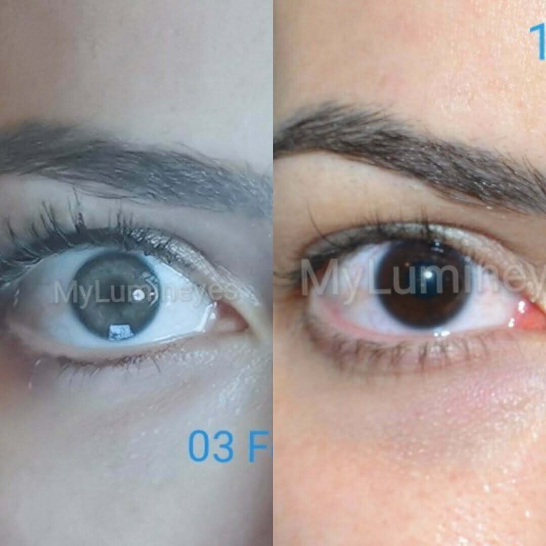 meilleure clinique de changement de couleur des yeux