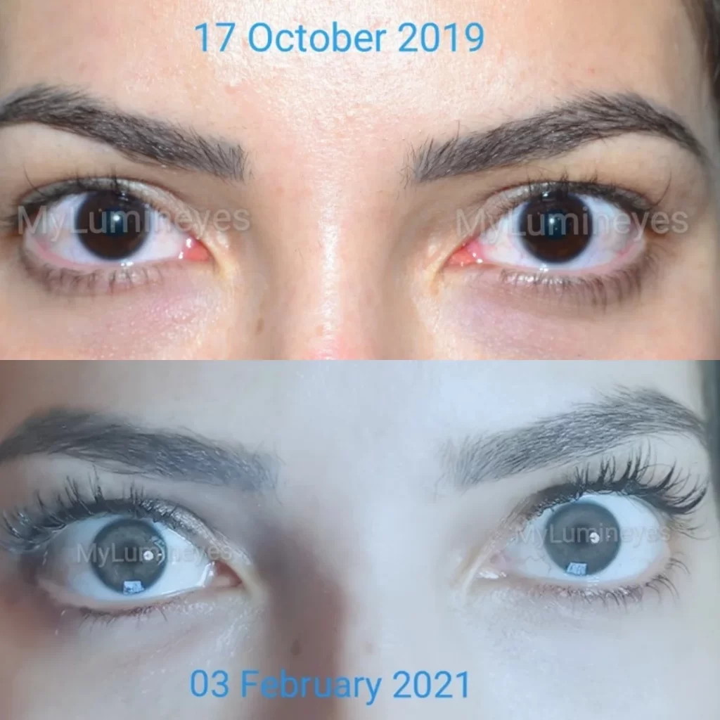 cambiamento di colore degli occhi del laser Costo della Turchia-recensioni gocce che cambiano colore occhi 