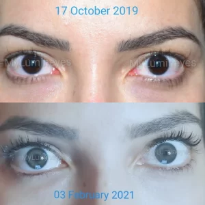 mudança de cor dos olhos a laser Custos da Turquia