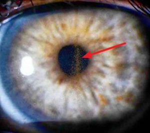 heterocromia-pigmentaria-glaucoma
