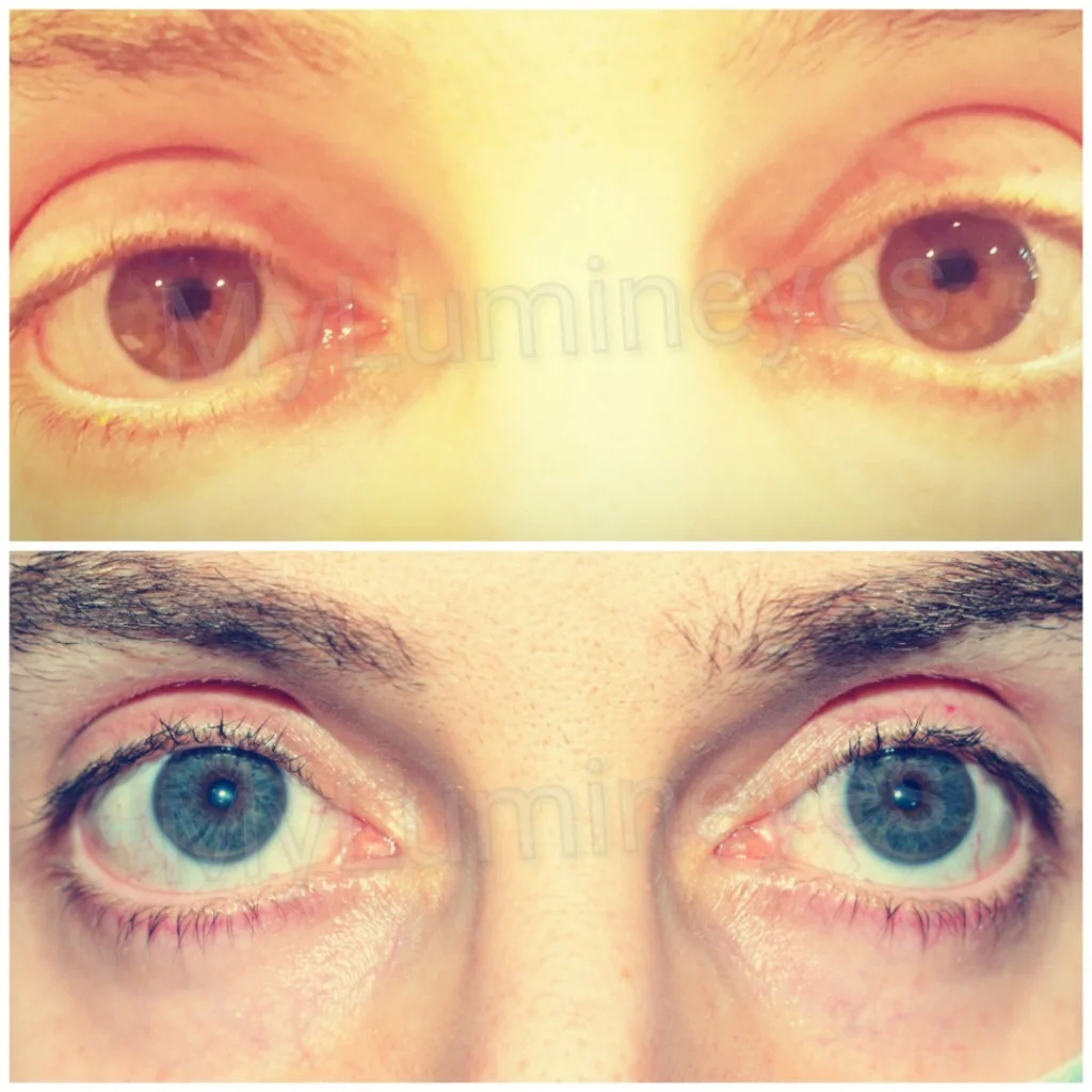 unsuccessful-eye- cirurgia de mudança de cor