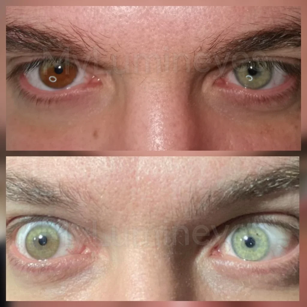 seltenste Augenfarbe-augenfarbe operation