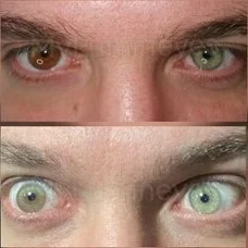 A mudança permanente da cor dos olhos do Lumineye