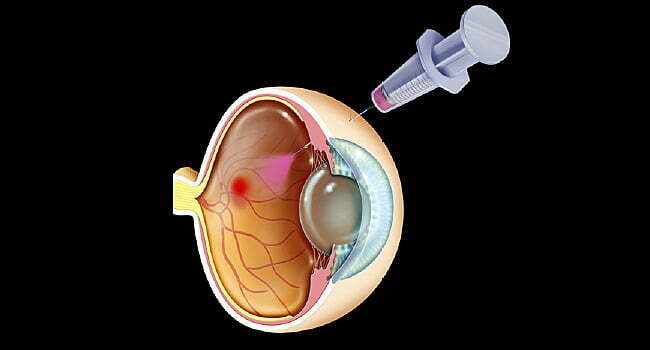 Anti-VEGF needle retina amd treatment laser