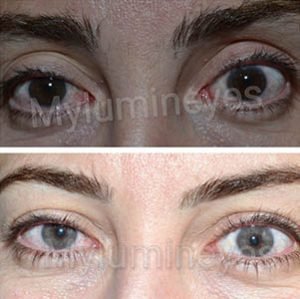 laser eye color change before and after