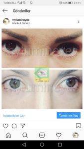before after photos video Turkey laser eye color