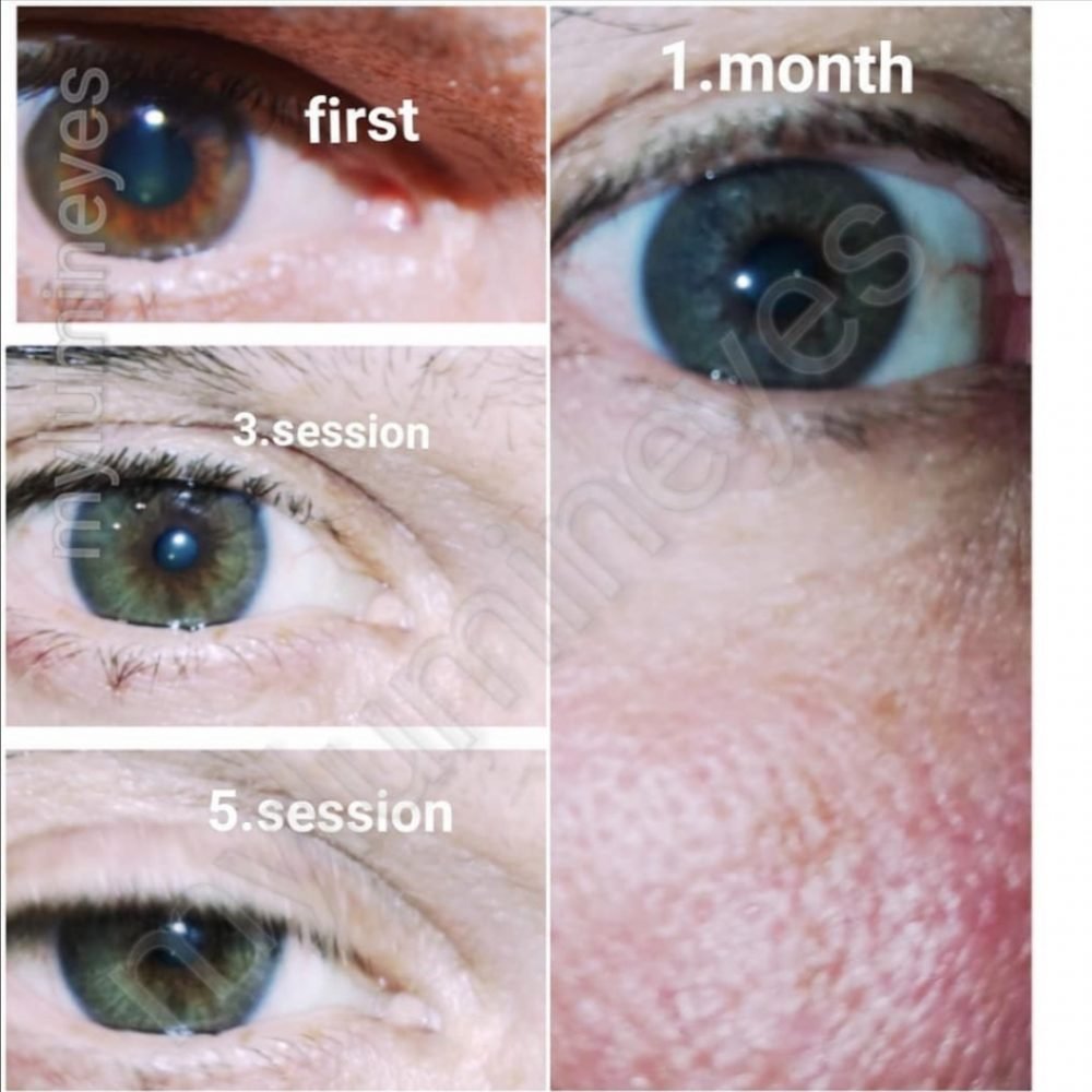 MYlumineyes Laser Eye Color Change Center Lumineyes Laser Eye Color