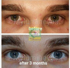 eye color change surgery photos before after