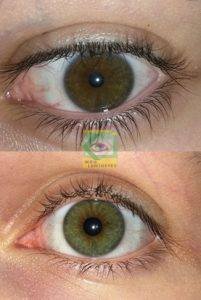 before-after-lumineyes-turkey-dr.mustafa-mete10
