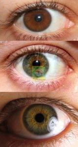 before-after-lumineyes-turkey-dr.mustafa-mete18