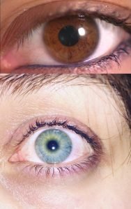 before after lumineyes turkey dr.mustafa mete5