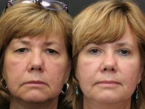 blepharoplasty Turkey costs prices aesthetic eyelid surgery costs