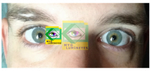 eye-color-change-laser-mylumineyes3 (1)