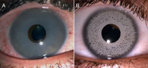 iris-implant-surgery-costs