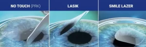 smile prk no touch lasik costo de la cirugía ocular en Turquía