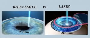 smile laser turkey dr mustafa mete
