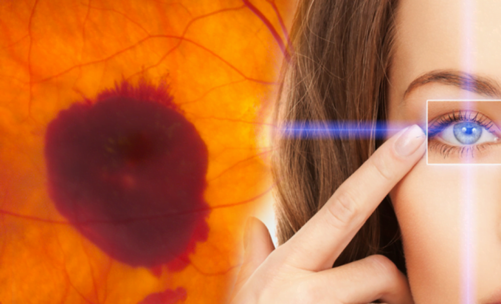 Retinal tear laser surgery hole and Anti-VEGF Photodynamic Therapy