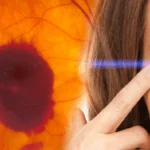 Retinal Tear Laser Surgery And Anti-VEGF