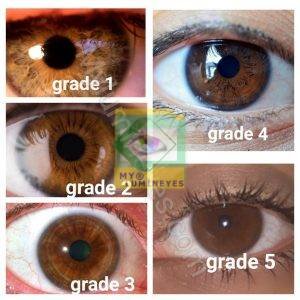 hazel-eye-color-grade-brown-laser-change