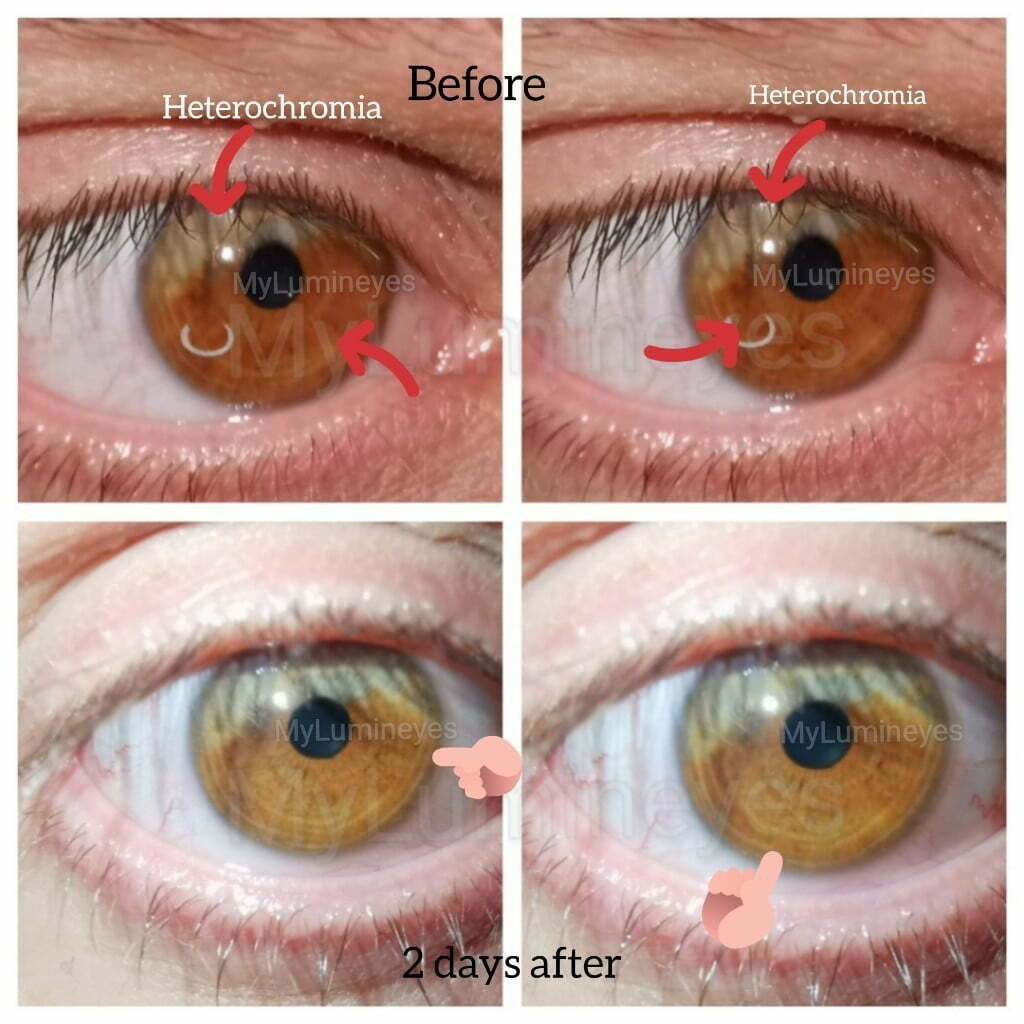heterocromia-laser- tratamiento-lumineyes