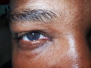 before and after eye color change surgery