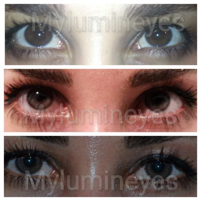 Is Laser Eye Color Change Safe? Eye Color Change Surgery Safety And Risks