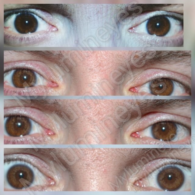 MYlumineyes Eye Center laser eye color change operation Turkey