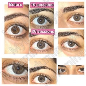 laser eye color change new photos