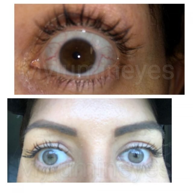 MYlumineyes Eye Center Lumineyes láser cambio de color de ojos estambul