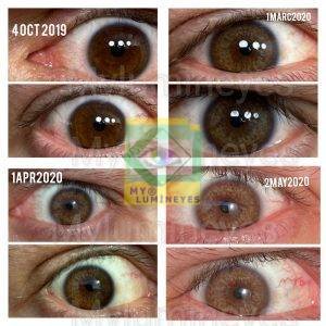 laser-eye-color-change-turkey-prices