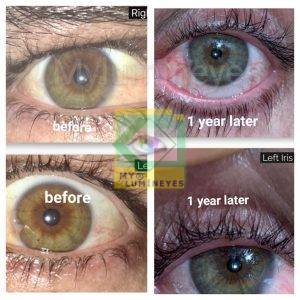 laser eye color before after change