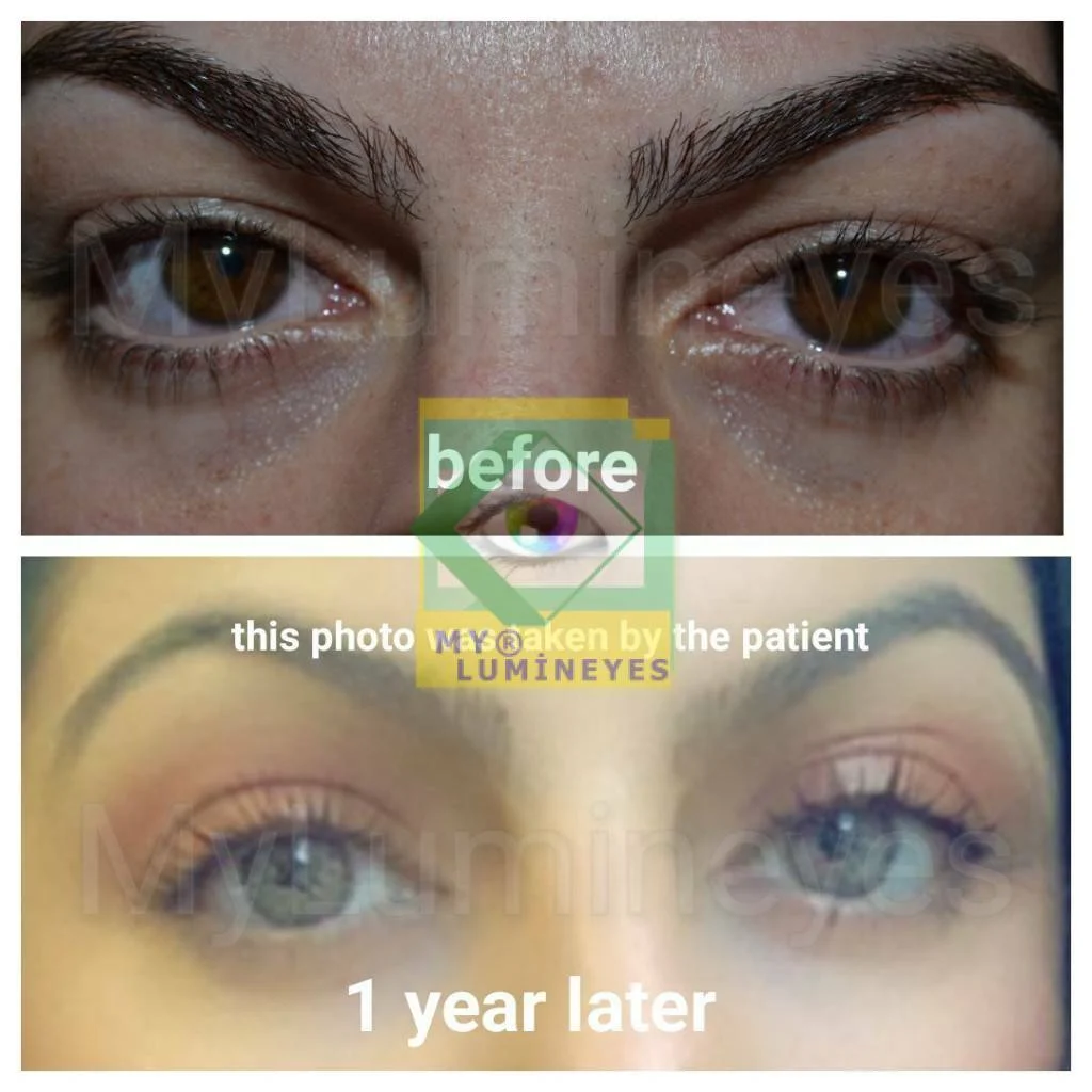 Reviews of the Best Surgery for Changing Eye Color 2 eye color change surgery reviews