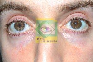 laser eye color change turkey