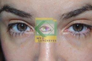 laser eye color change turkey