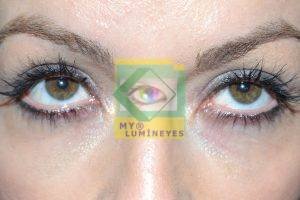 laser eye color change turkey