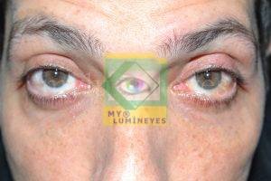 eye color change turkey