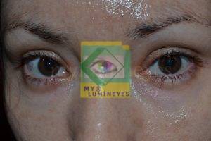 eye color change turkey