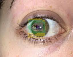 laser eye color change istanbul