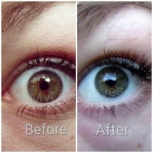 brown eyes to green-hazel eyes color with lumineyes laser eye color change surgery