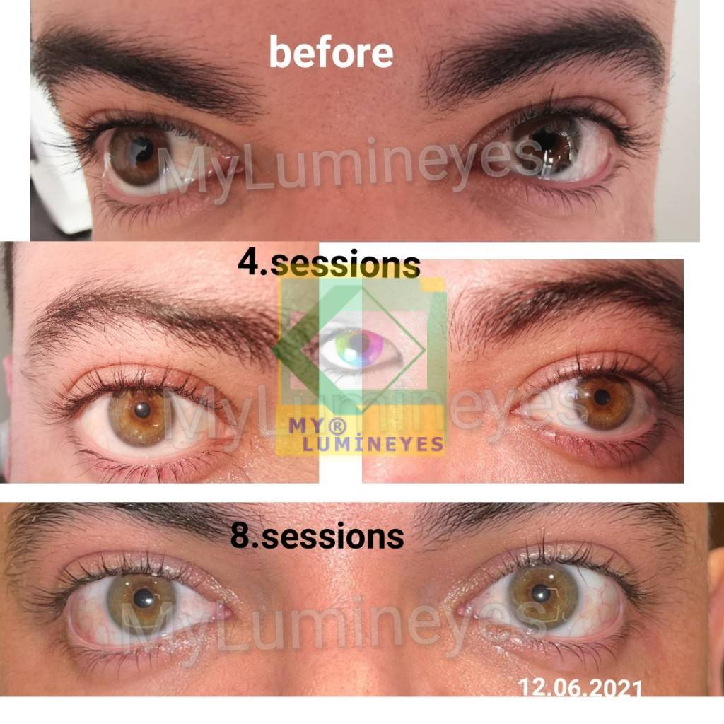 before and after photos videos eye color change
