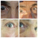 eye color changing before after photos
