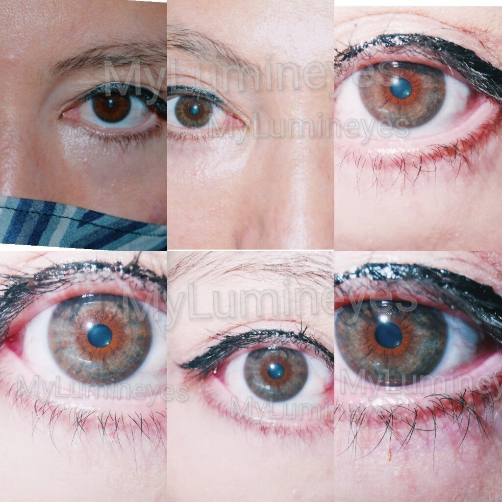 eye color change surgery reviews