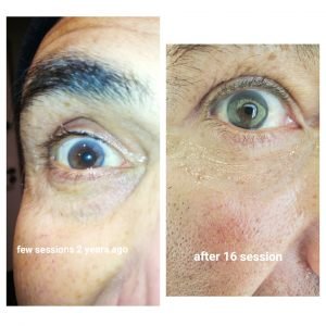 brown-to-blue-contact-lens-laser-eye-color-change-istanbul-2