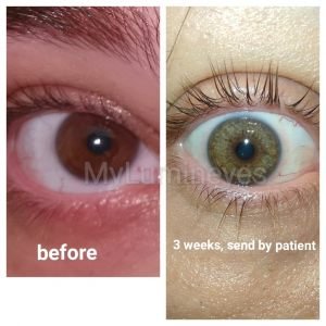 brown-to-green-laser-eye-color-change
